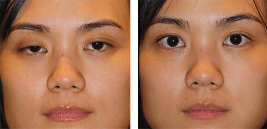  Before and After Picture  
39 year old female - Upper Eyelid Ptosis (Droopy Eyelids) Repair