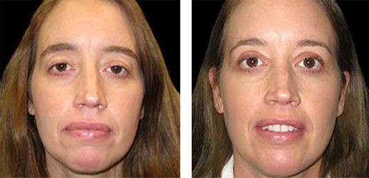  Before and After Picture  
42 Year Old Female - Bilateral Upper Eyelid Ptosis (Droopy Eyelids) Repair