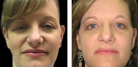  Before and After Picture  
36 Year Old Female - Bilateral Upper Eyelid Ptosis (Droopy Eyelids) Repair