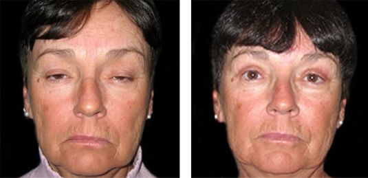  Before and After Picture  
62 Year Old Female - Bilateral Upper Eyelid Ptosis (Droopy Eyelids) Repair