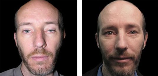  Before and After Picture  
42 Year Old Male - Bilateral Upper Eyelid Ptosis (Droopy Eyelids) Repair
