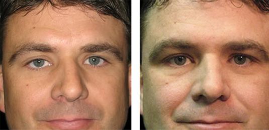  Before and After Picture  
41 Year Old Male - Right Upper Eyelid Ptosis (Droopy Eyelids) Repair