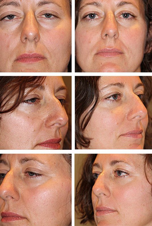  Before and After Picture  
41 year old female - bilateral upper lid ptosis repair, bilateral lower blepharoplasty