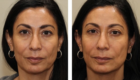  Before and After Picture  
49 Year Old Female - Restylane to Tear Troughs and Nasolabial Folds