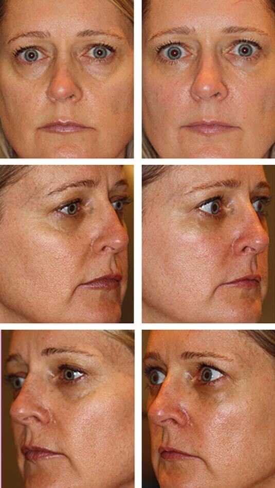  Before and After Picture  
47 Year Old Female - Bilateral Lower Lid Restylane