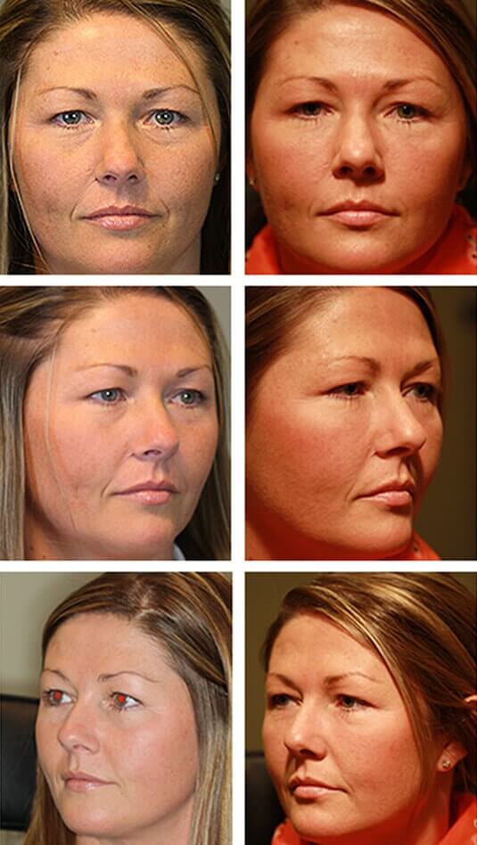  Before and After Picture  
37 Year Old Female - Bilateral Lower Lid Restylane