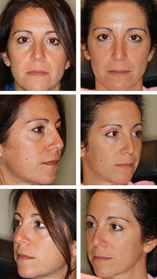 Before and After Picture  
38 Year Old Female - Bilateral Lower Lid Restylane