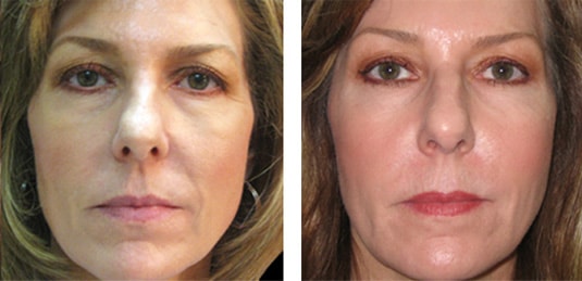  Before and After Picture  
48 Year Old Female - Restylane® to Tear Trough