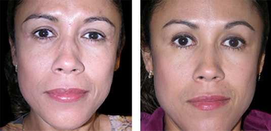  Before and After Picture  
41 Year Old Female - Botulinum Toxin injected in frown lines
