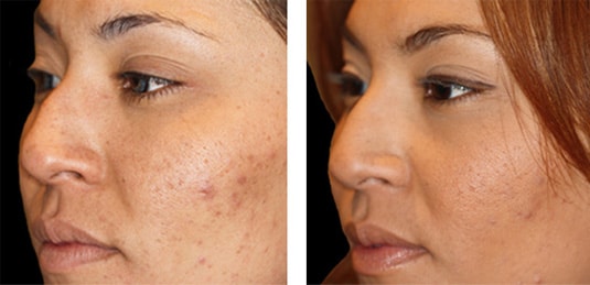  Before and After Picture  
29 Year Old Female - Restylane® to Nose