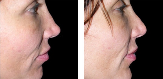  Before and After Picture  
Female with Restylane® to Nose