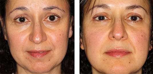  Before and After Picture  
50 Year Old Female - Restylane to Lower Lids and Nasolabial Folds