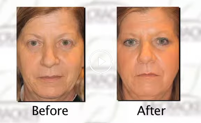 Dr. Michael explained about Facial aging video - Click to see