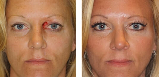  Before and After Picture  
40 Year Old Female - Repair of left upper lid defect after skin cancer excision.