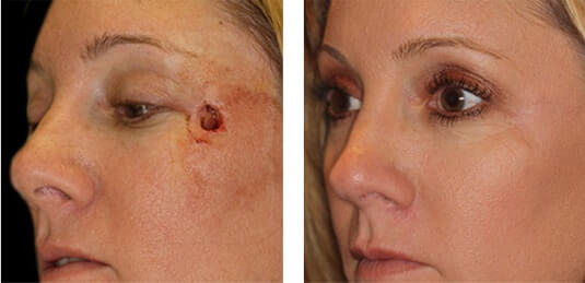  Before and After Picture 
40 Year Old Female - Repair of left cheek defect after skin cancer excision.