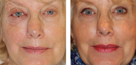  Before and After Picture  
66 Year Old Female - Repair of right lower lid defect after skin cancer excision.