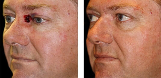  Before and After Picture  
50 Year Old Male - Repair of right medial canthal defect after skin cancer excision.