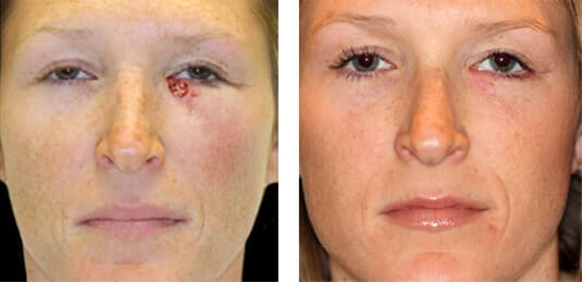  Before and After Picture  
31 Year Old Female - Repair of left lower lid defect after skin cancer excision.