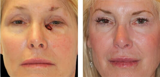  Before and After Picture  
54 Year Old Female - Repair of left lower lid defect after skin cancer excision.