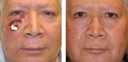  Before and After Picture 
65 Year Old Male - Repair of right lower lid defect after skin cancer excision.