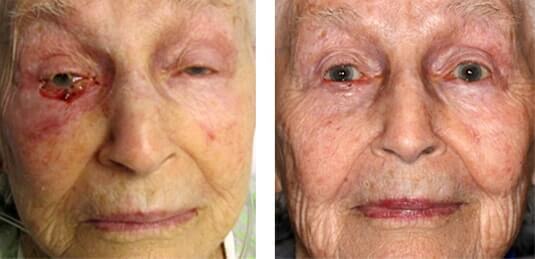  Before and After Picture 
95 Year Old Female - Repair of right lower lid defect after skin cancer excision.