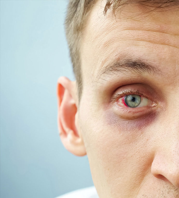 stock image of male model having eyelid tumor