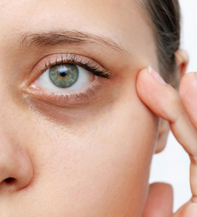 stock image of model showing her dark circles under eye