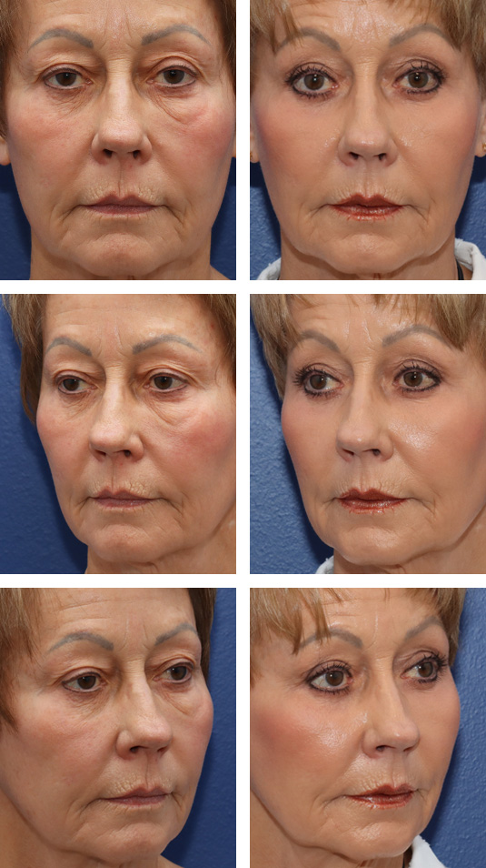  Before and After Picture 
67 Year Old Female – Upper and Lower Blepharoplasty Bilateral Upper Lid Ptosis Repair, Excision of Fat Previously Injected to the Lower Lids, and Periocular Laser Skin Resurfacing.  A small amount of lower lid skin was excised.