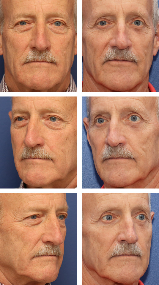  Before and After Picture  
70 Year Old Male – Upper and Lower Blepharoplasty with Internal Brow Pexies and Lower Lid Skin Muscle Flap Excision.
