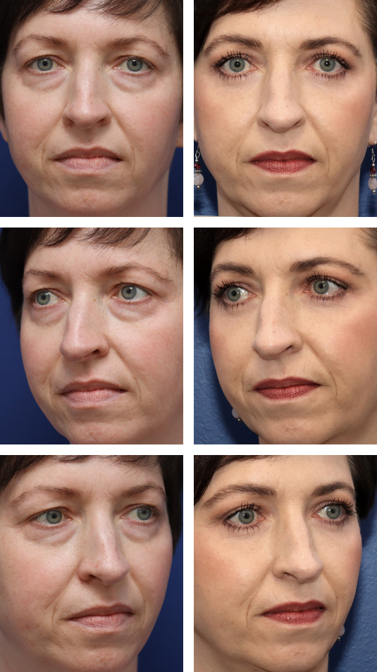  Before and After Picture 
49 Year Old Female – Upper and Lower Blepharoplasty with Periocular Laser Skin Resurfacing. No lower lid skin incisions were made.