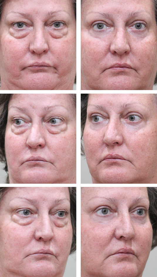  Before and After Picture 
60 Year Old Female – Upper and Lower Blepharoplasty with Laser Skin Resurfacing