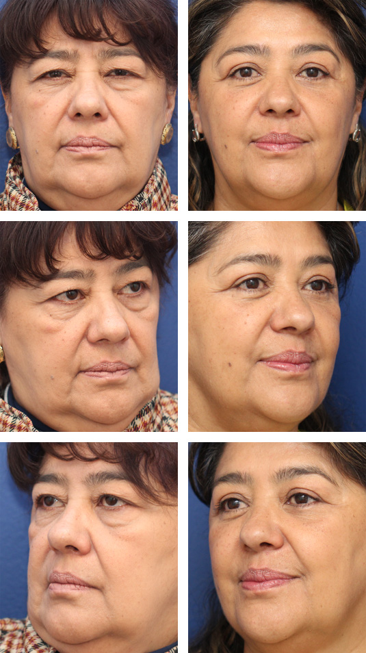  Before and After Picture 
60 Year Old Female – Upper and Lower Blepharoplasty.  A lower lid skin muscle flap was used.
