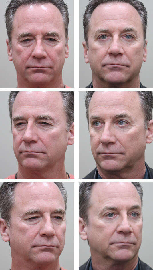 Before and After Picture  
59 Year Old Male - Upper and Lower Blepharoplasty 