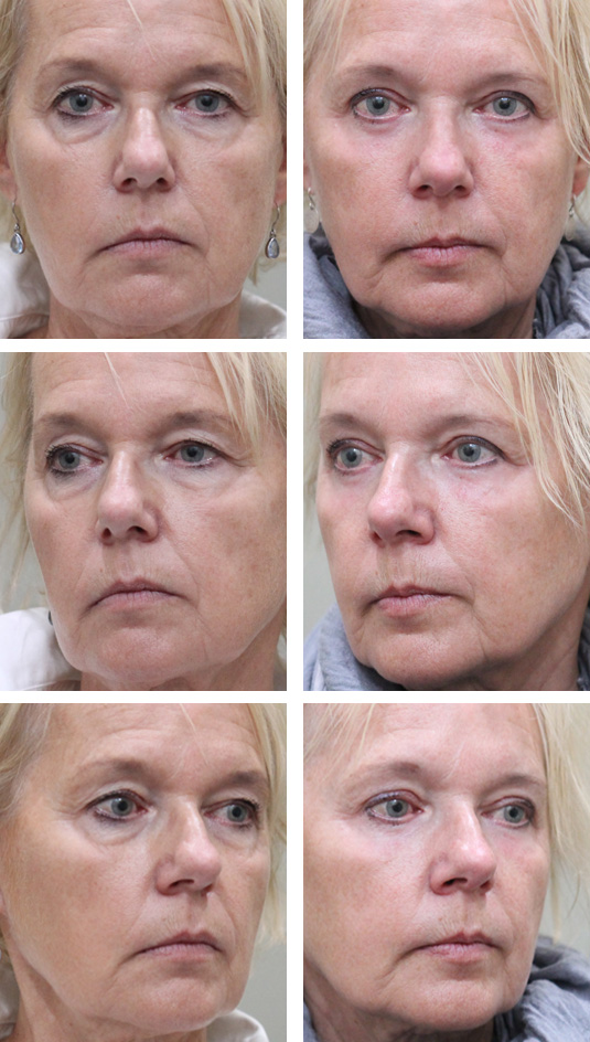  Before and After Picture 
62 Year Old Female - Upper and Lower Blepharoplasty with Laser Skin Resurfacing