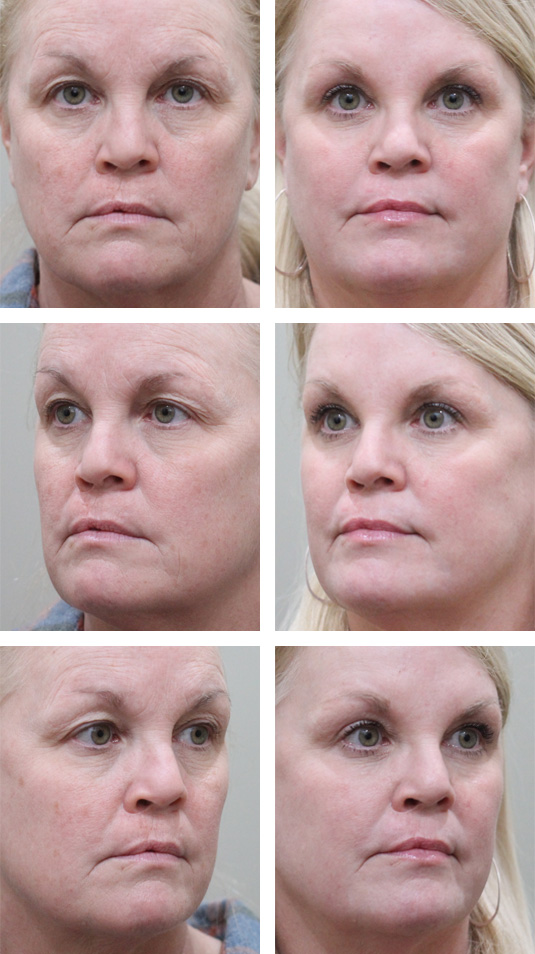 Before and After Picture 
52 Year Old Female – Upper and Lower Blepharoplasty with Full Face Erbium Laser Skin Resurfacing.