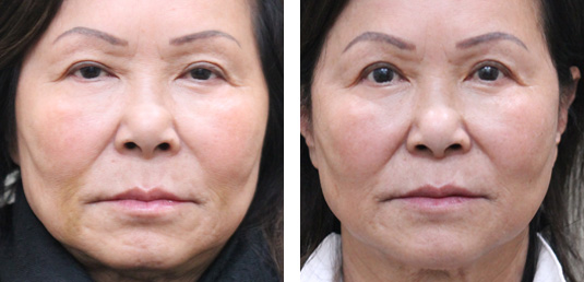  Before and After Picture  
68 Year Old Female - Upper Blepharoplasty and Upper Lid Ptosis Repair