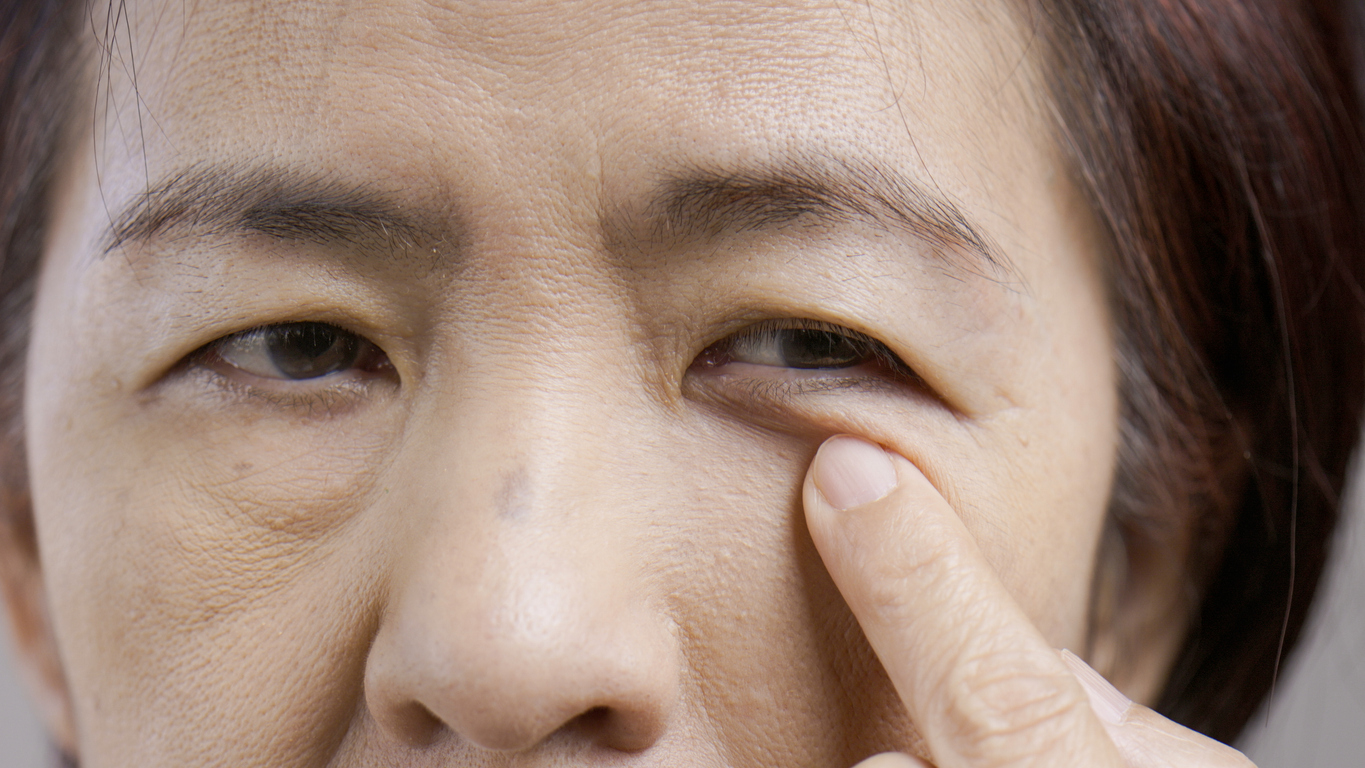 The image shows a senior Asian woman with drooping lids to represent what causes ptosis.