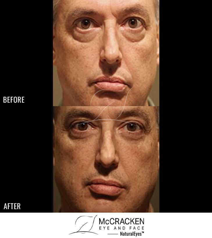 53 Year Old Male – Restylane to Lower Lids